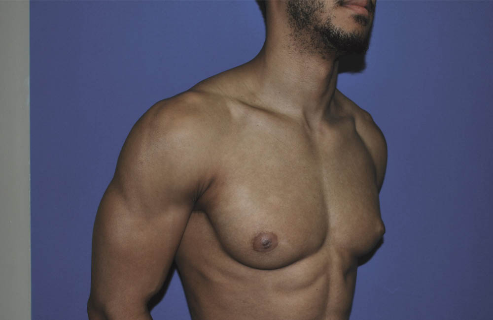 Male Breast Reduction case #4908