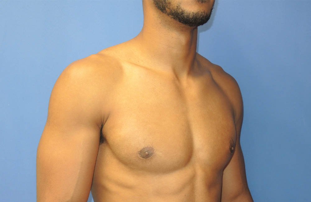 Male Breast Reduction case #4908