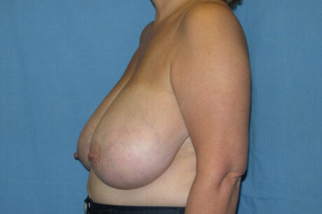 Breast Reduction case #4086