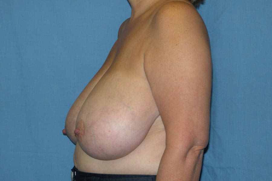 Breast Reduction case #4086
