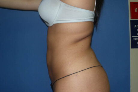 Liposuction case #4568