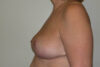 Breast Reduction case #4086