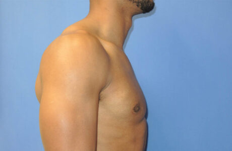 Male Breast Reduction case #4908