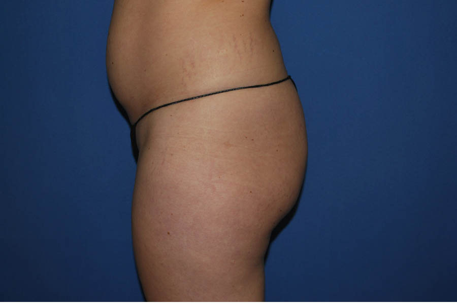 Liposuction case #4568