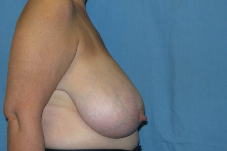Breast Reduction case #4086