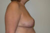 Breast Reduction case #4086