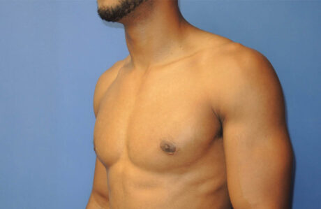 Male Breast Reduction case #4908