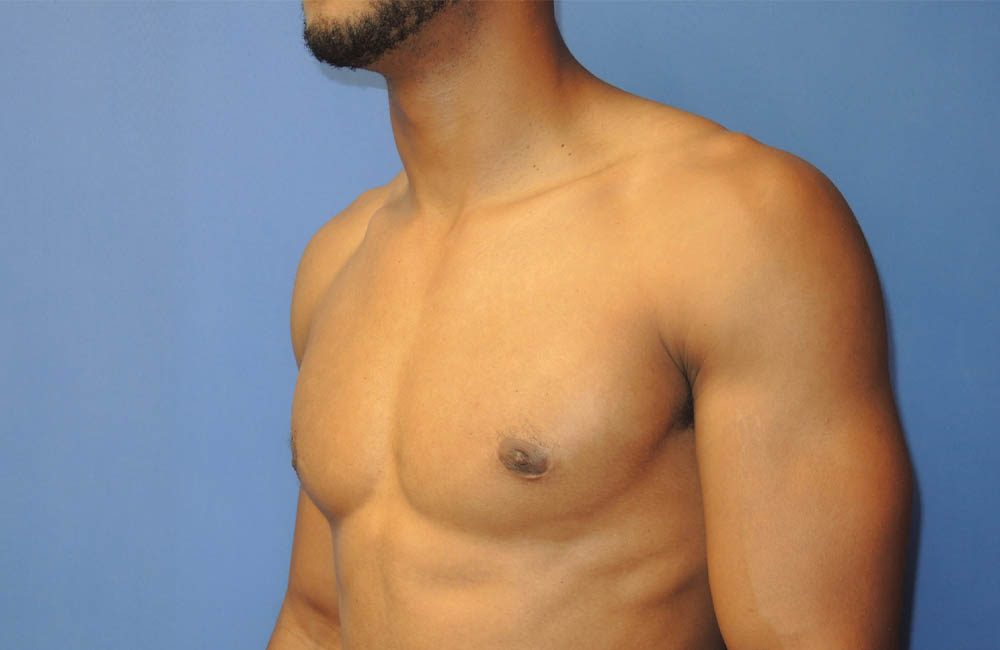 Male Breast Reduction case #4908