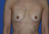 Breast Augmentation case #3963