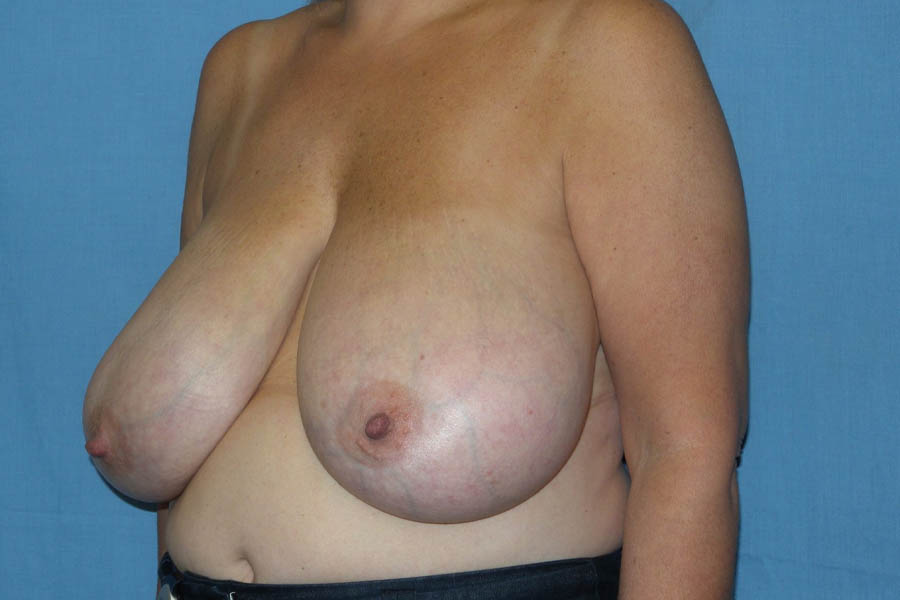 Breast Reduction case #4086