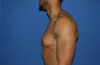 Male Breast Reduction case #4908