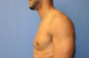 Male Breast Reduction case #4908