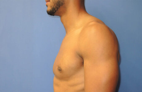Male Breast Reduction case #4908