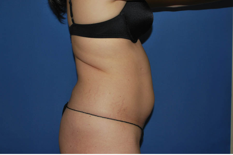 Liposuction case #4568