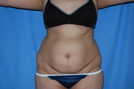 Mommy Makeover case #5563