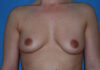 Breast Augmentation case #3974