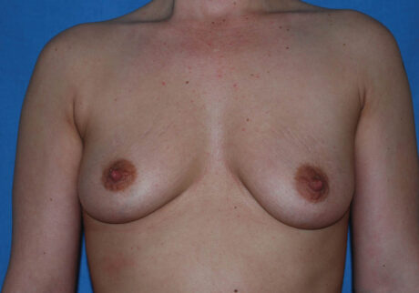 Breast Augmentation case #3974