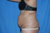 Mommy Makeover case #5563