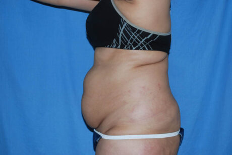 Mommy Makeover case #5563