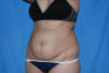 Mommy Makeover case #5563