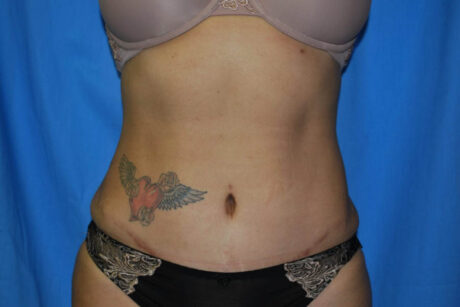 Mommy Makeover case #5578
