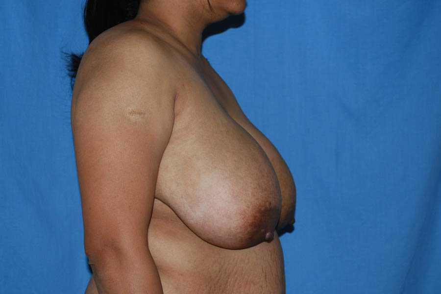 Breast Reduction case #4097