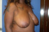 Breast Reduction case #4108