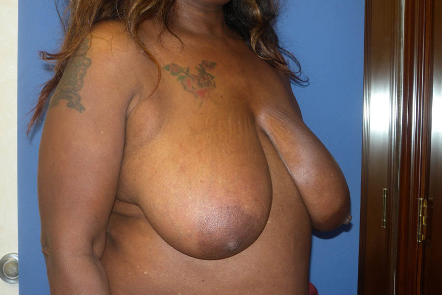Breast Reduction case #4108