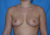Breast Augmentation case #3997