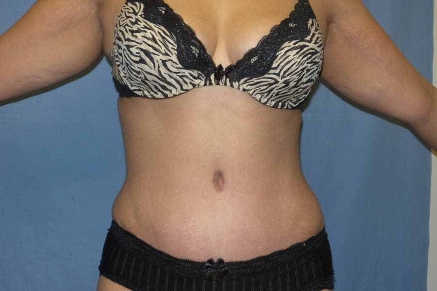 Mommy Makeover case #5537