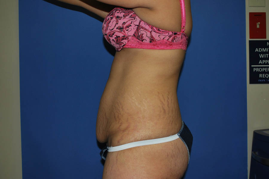 Mommy Makeover case #5537