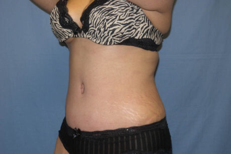 Mommy Makeover case #5537