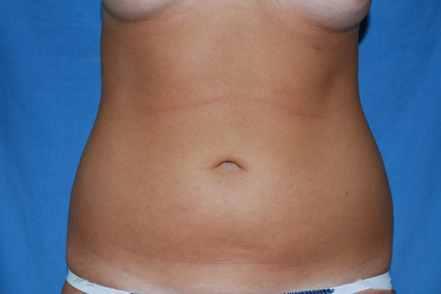 Liposuction case #4596