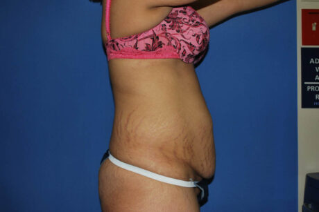 Mommy Makeover case #5537