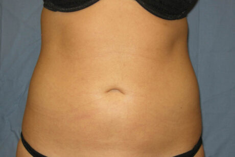 Liposuction case #4596