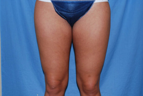 Liposuction case #4596