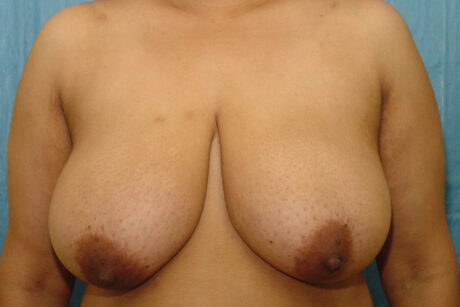 Breast Reduction case #4126