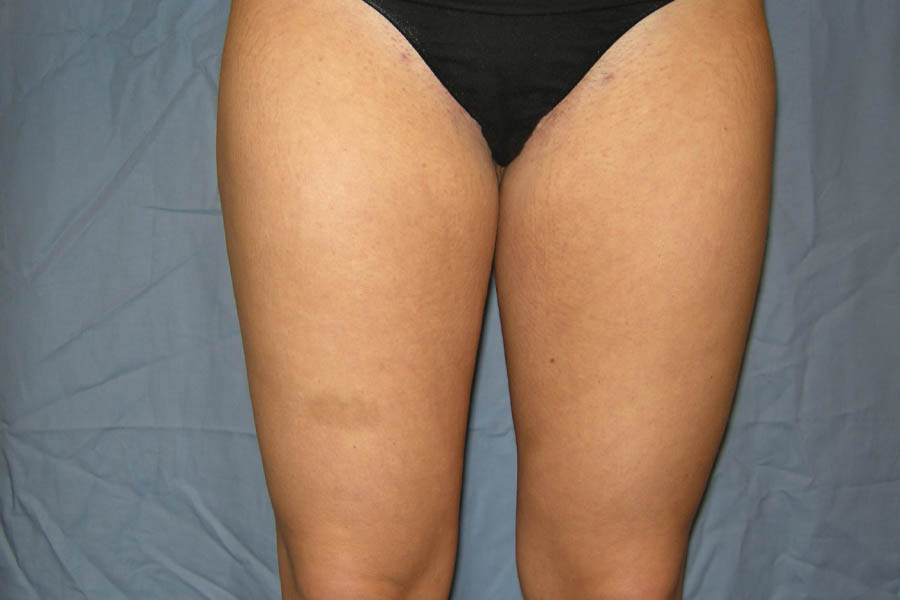 Liposuction case #4596