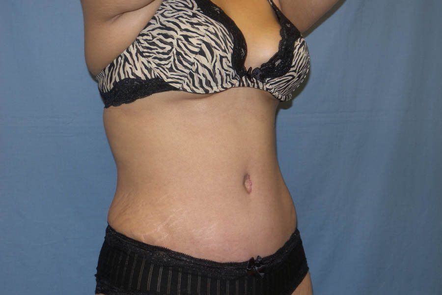 Mommy Makeover case #5537