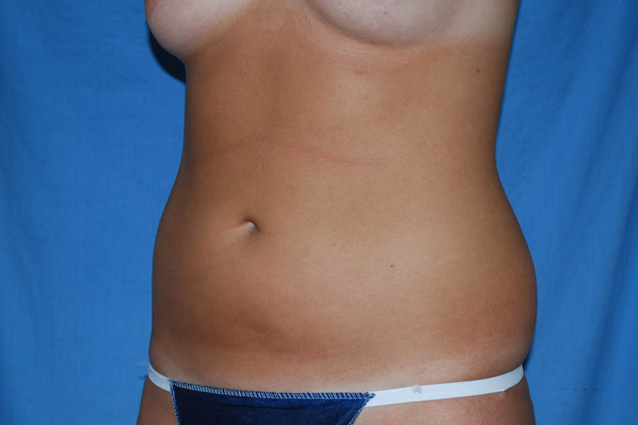 Liposuction case #4596