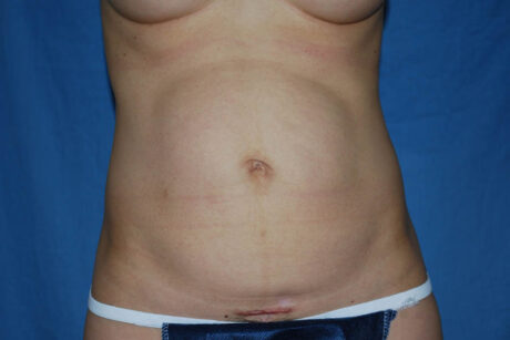 Mommy Makeover case #5517