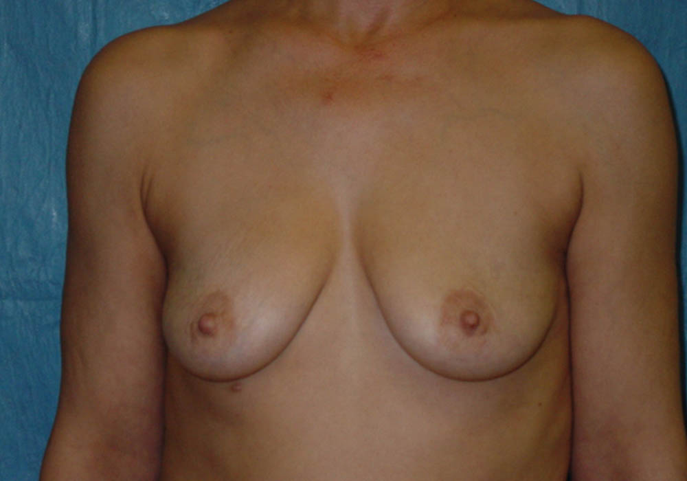 Breast Augmentation case #4009