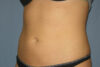 Liposuction case #4596