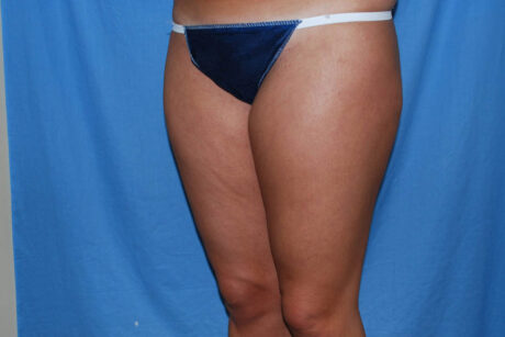 Liposuction case #4596