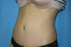 Mommy Makeover case #5517