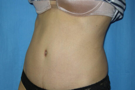 Mommy Makeover case #5517