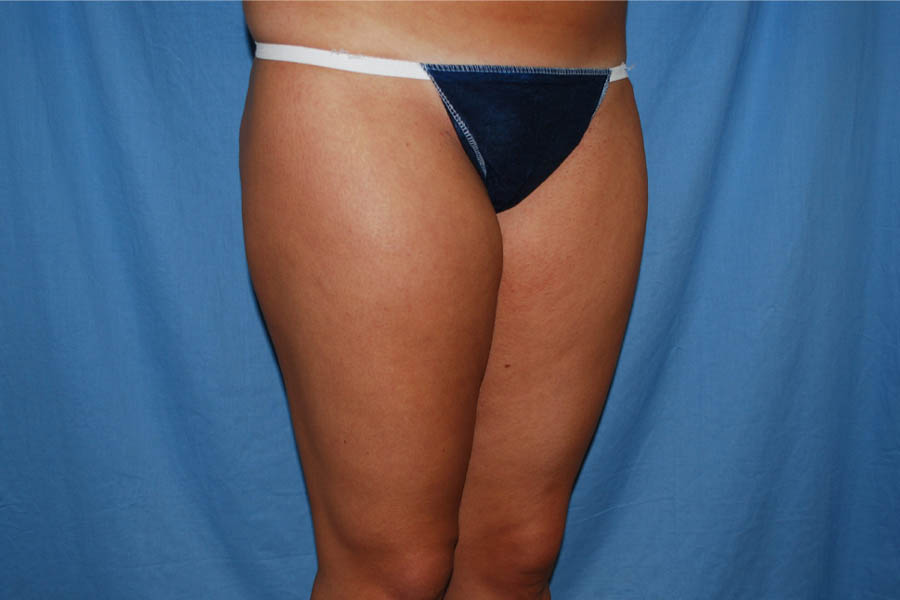 Liposuction case #4596