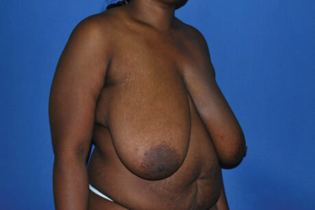 Breast Reduction case #4133