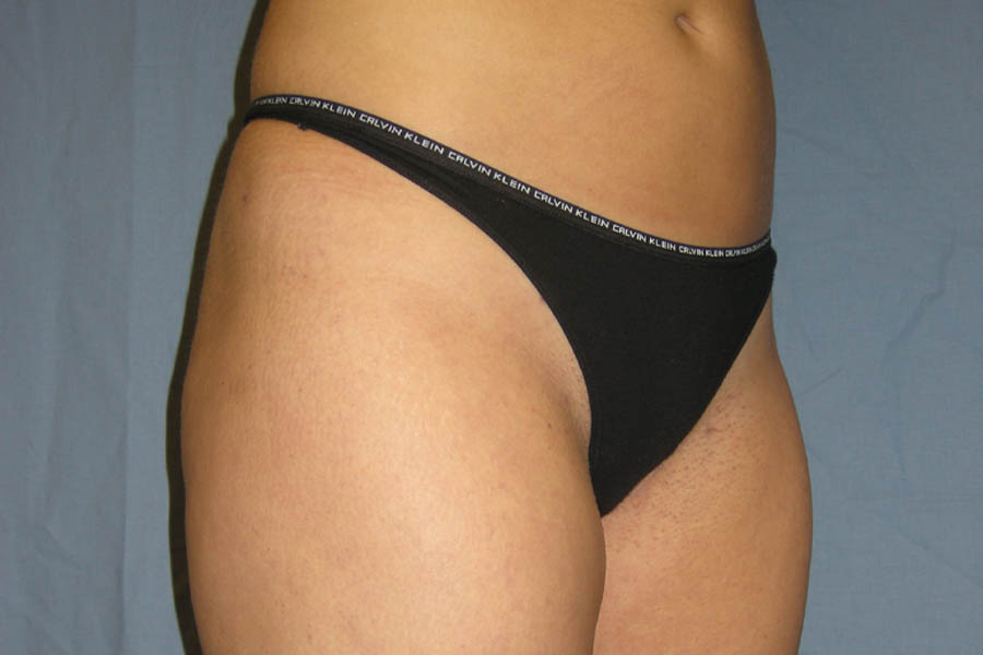 Liposuction case #4596