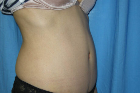 Mommy Makeover case #5517
